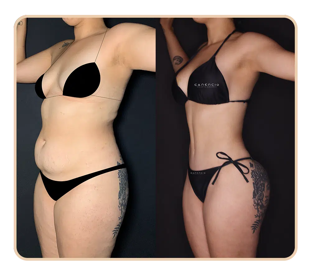 Resultado Mommy makeover