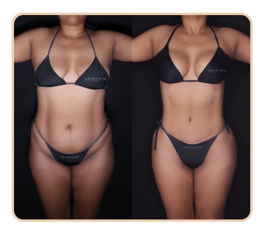 Resultado Mommy makeover