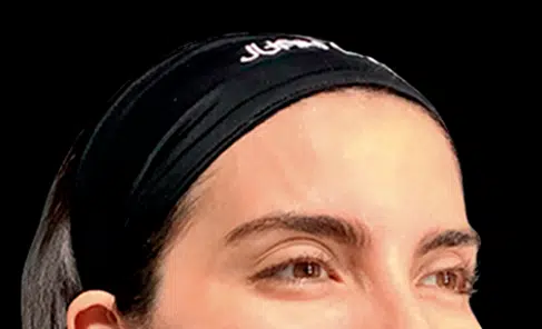 Toxina botulínica despues