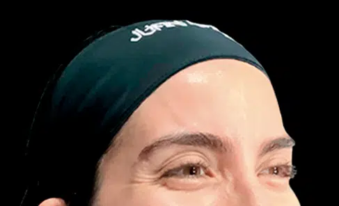 Toxina botulínica antes