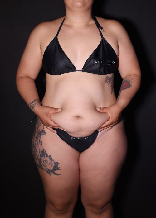 Abdominoplastia antes
