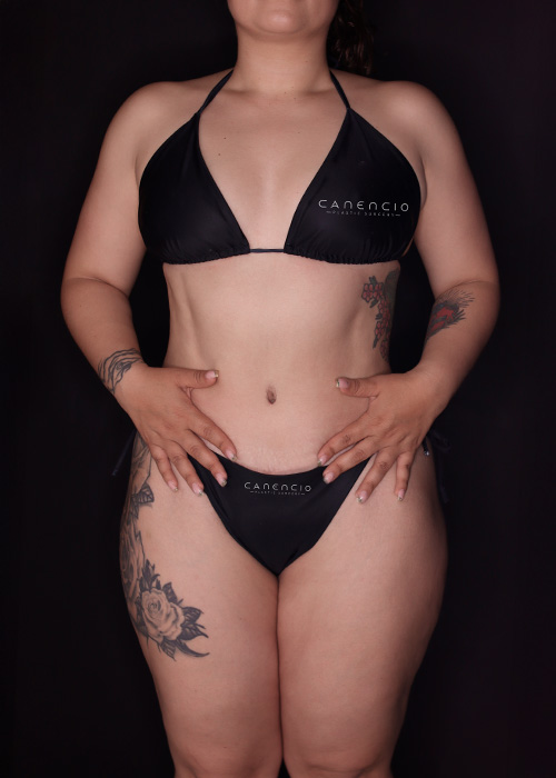 Abdominoplastia despues