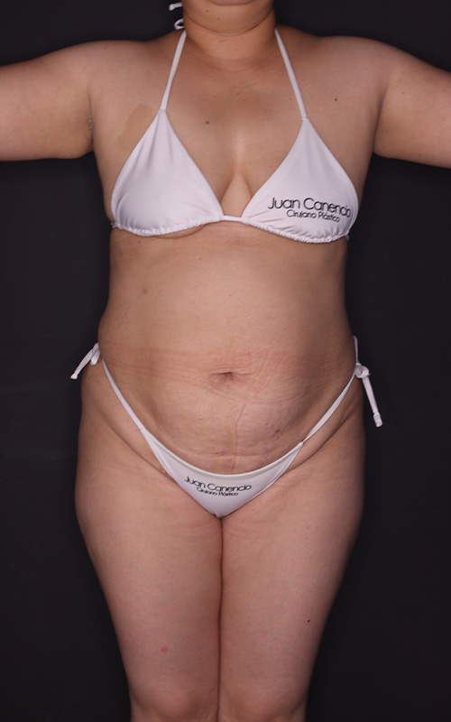 Abdominoplastia antes