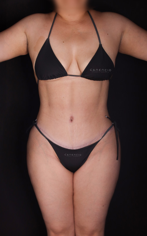 Abdominoplastia despues