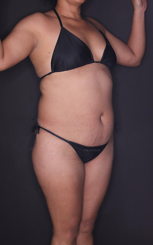 Abdominoplastia antes