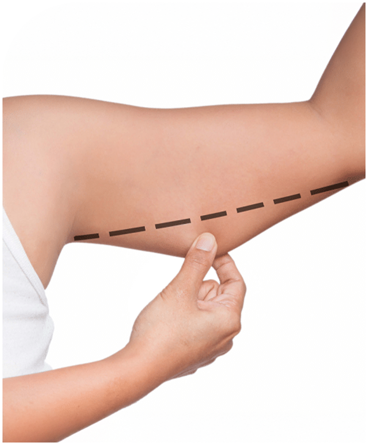 Braquioplastia