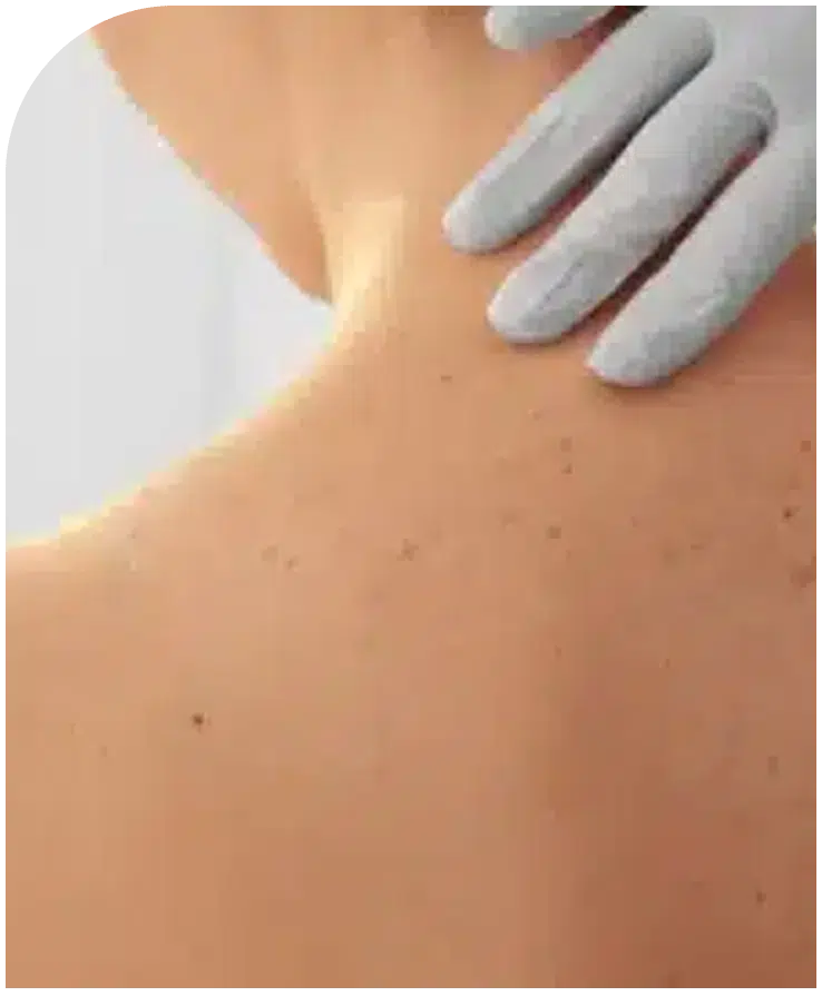 Cáncer de piel