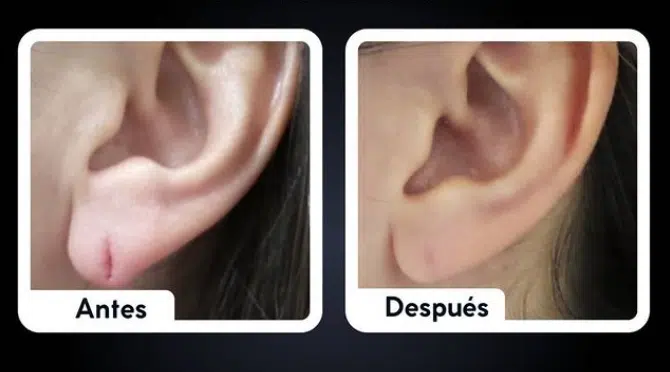 Cierre de fisura del lóbulo auricular