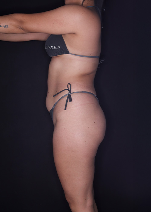 Lipo 360 antes