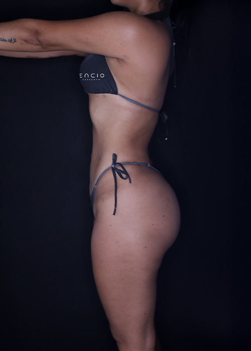 Lipo 360 despues