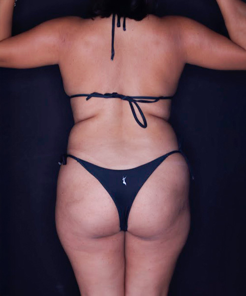 Lipoescultura antes