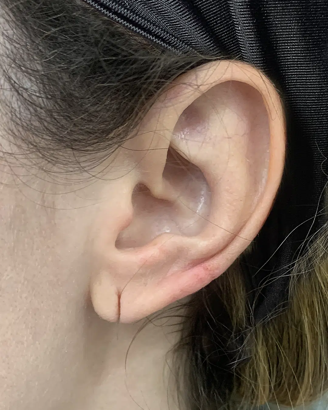 Cierre de fisura del lóbulo auricular antes