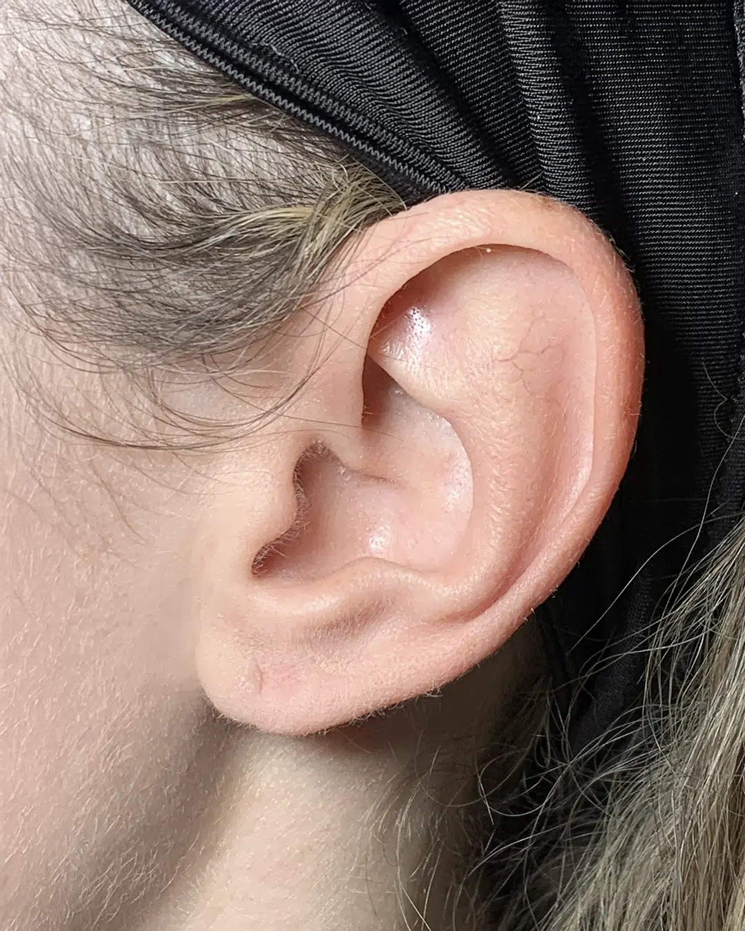 Cierre de fisura del lóbulo auricular después