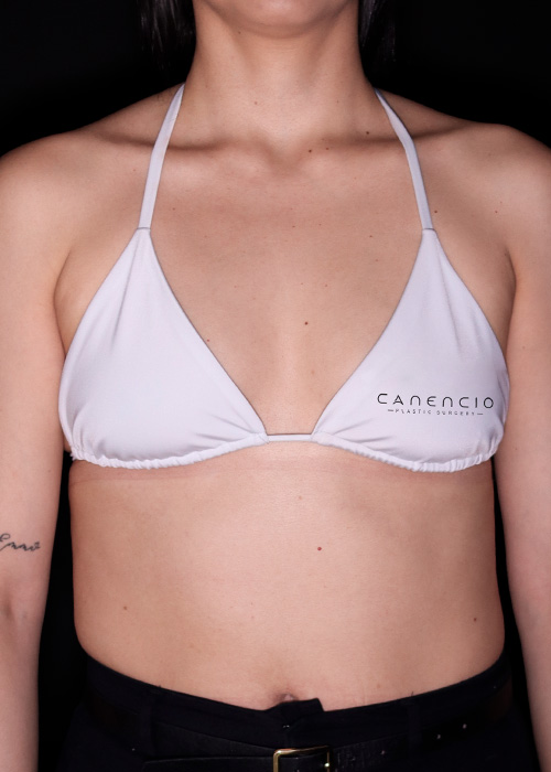 Mamoplastia antes