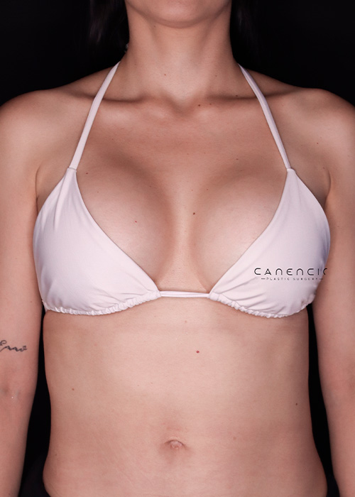 Mamoplastia despues