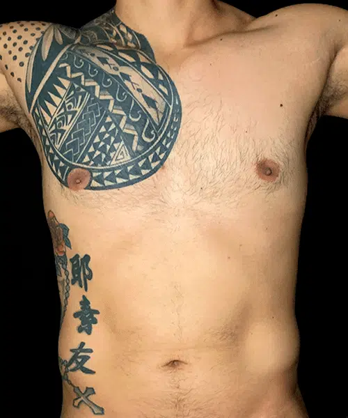 Marcación abdominal antes