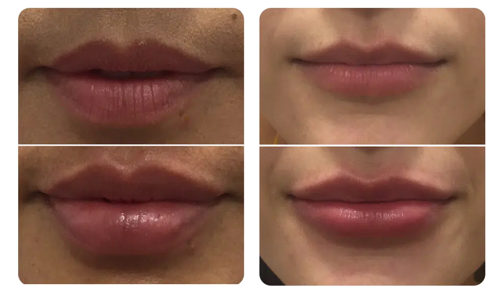 Redefinición de labios