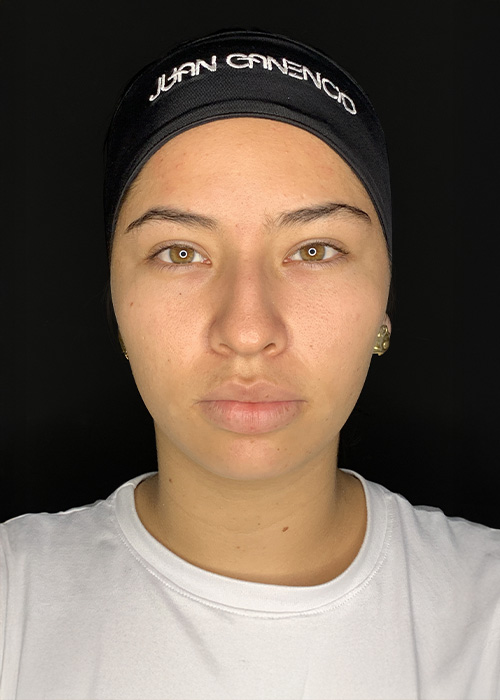 Rinoplastia antes