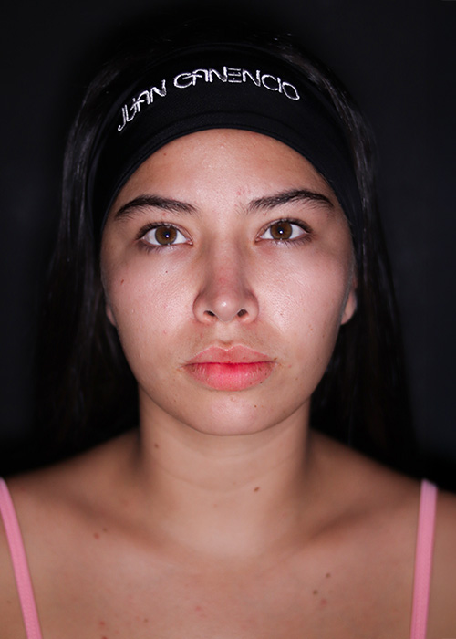 Rinoplastia despues