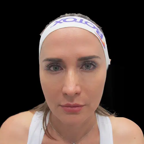 Full face despues